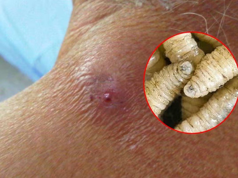 Jalisco reporta miasis humana por gusano barrenador en un paciente de Pihuamo