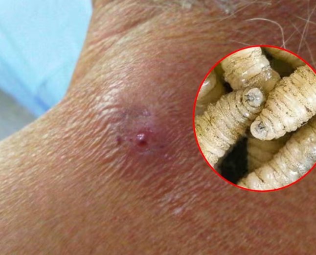 Jalisco reporta miasis humana por gusano barrenador en un paciente de Pihuamo